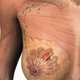 Getty Images/3D4Medical.com